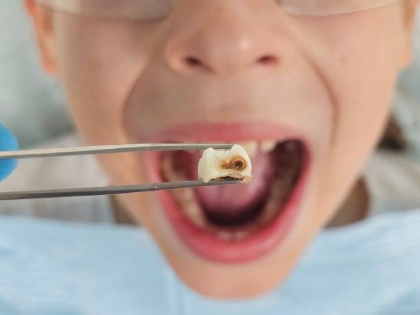 Best Emergency Tooth Extraction in East Lake Orient Park, FL
