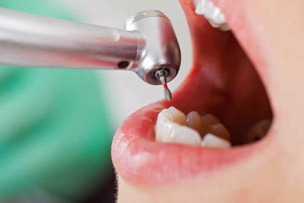 Best Emergency Tooth Extraction in East Lake Orient Park, FL